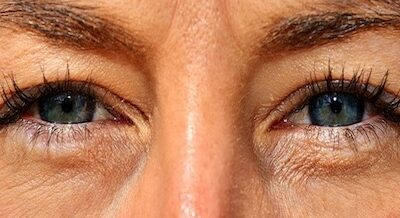 Schlupflider – wie entstehen sie und was kann helfen?